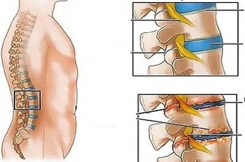As razóns para o desenvolvemento da osteocondrose lumbar