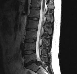 Opcións de diagnóstico para osteocondrosis lumbar