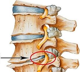 Por que a osteocondrose lumbar é