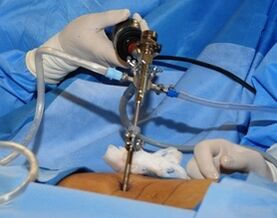 Tratamento cirúrxico da osteocondrose lumbar
