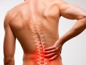 Dor lumbar debido á osteocondrose